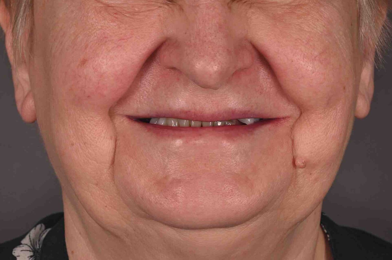 Pacient Clinica Dr. Alin Odor - Rezultat Implantologie